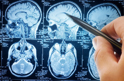 Trends in Brain Tumor Treatments